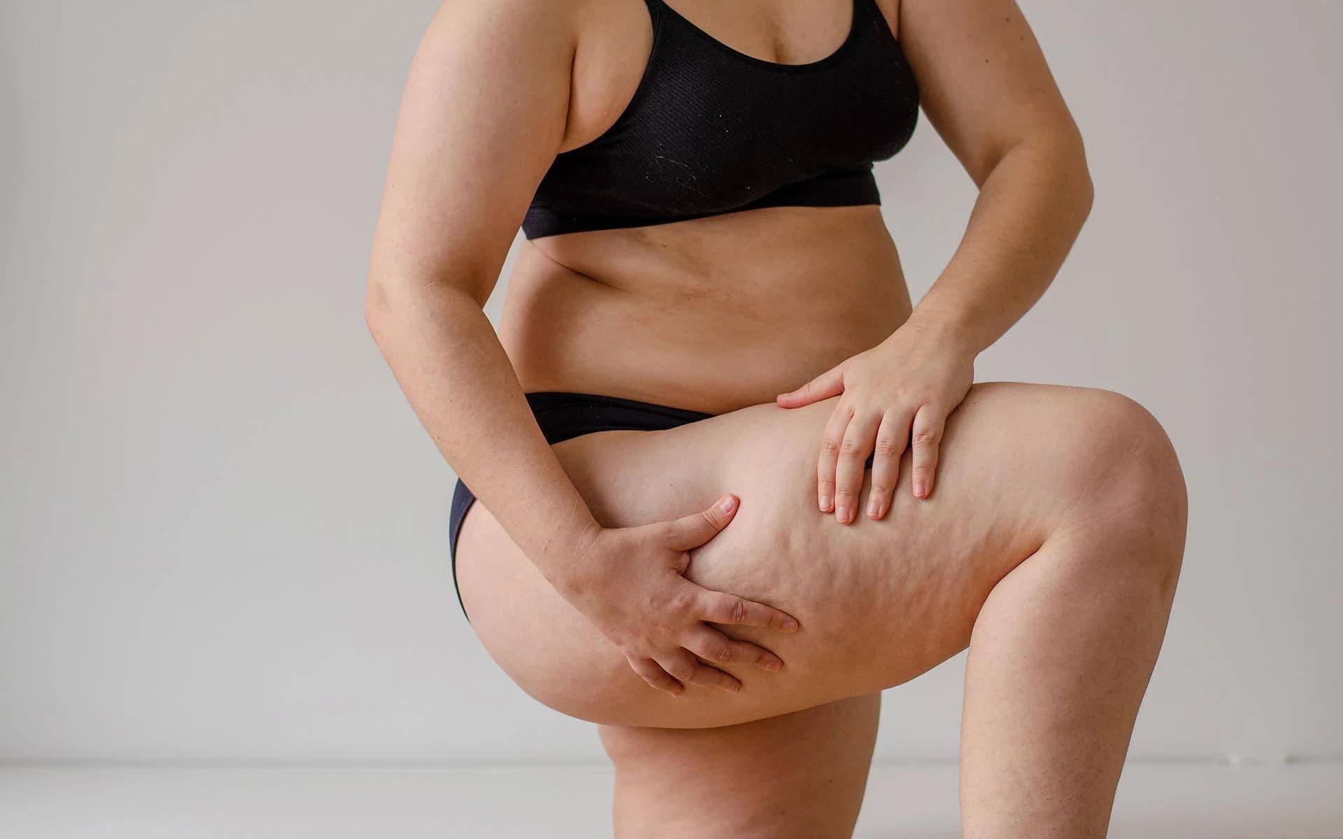 Lipödem und die Rolle der Hormone: Ein komplexer Zusammenhang