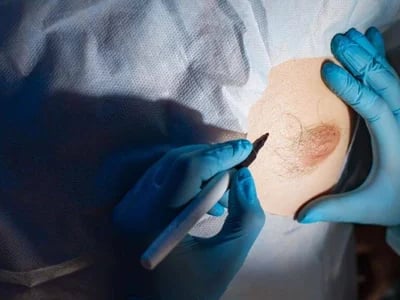 Wie die Brustvergrößerung mit Eigenfett zur Körperformung beiträgt