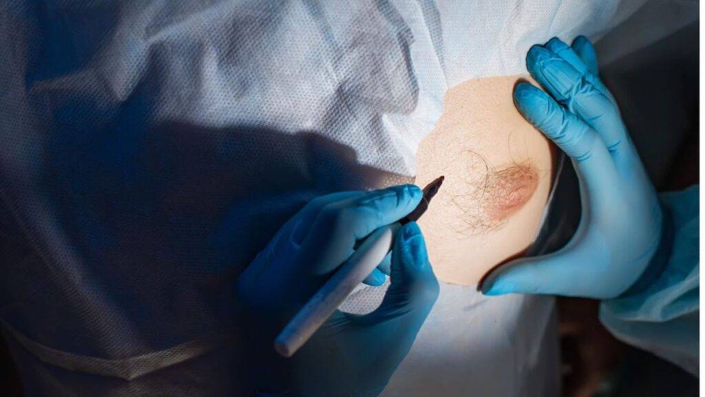 Wie die Brustvergrößerung mit Eigenfett zur Körperformung beiträgt