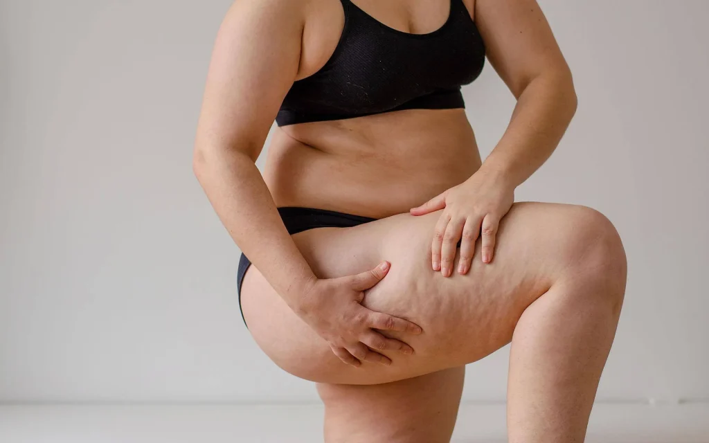 Lipödem und die Rolle der Hormone: Ein komplexer Zusammenhang